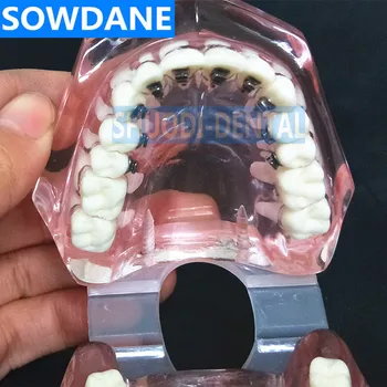 Zobni Ortodontskega Model Z Jezikovna Nosilci za Zobozdravnik-Pacient Komunikacijske Študije Pregleden Model Zob