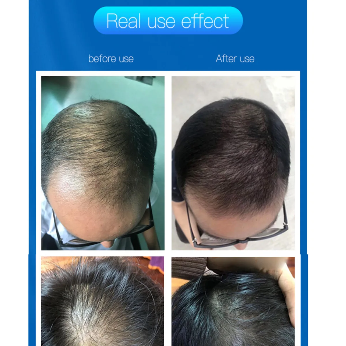 LCD-Zaslon Laser Terapija Rast Las Čelada Anti Hair Loss Naprave Zdravljenje Anti Hair Loss Spodbujajo rast Dlak Skp Masaža